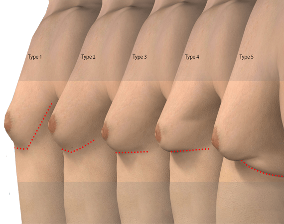 Male Breast Reduct