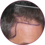 hairline transplant in indore