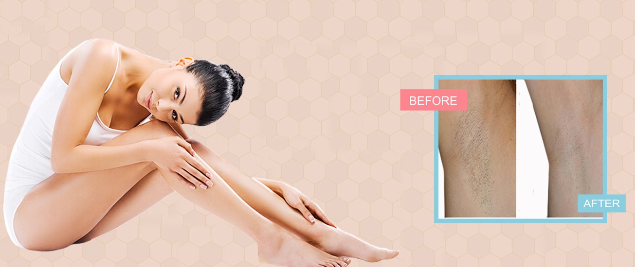 laser hair removal in bhopal