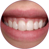 Composite Bonding dental indore
