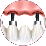 Dental Implants in indore