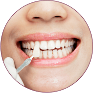 teeth Laminates in indore