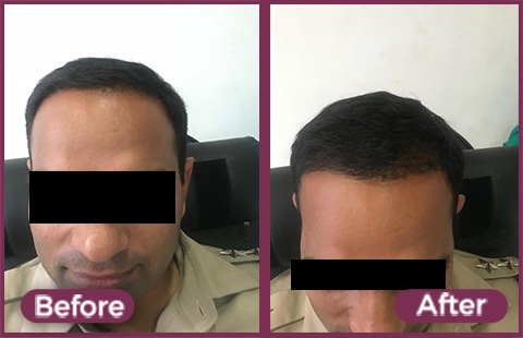 Hair Transplant Before and After