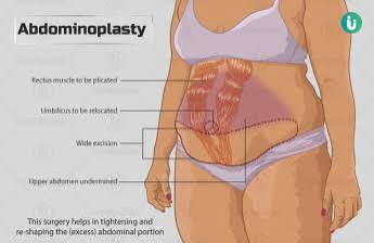 Abdominoplasty Tummy Tuck
