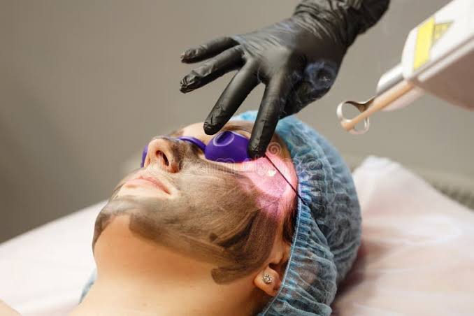 Carbon Laser Facial