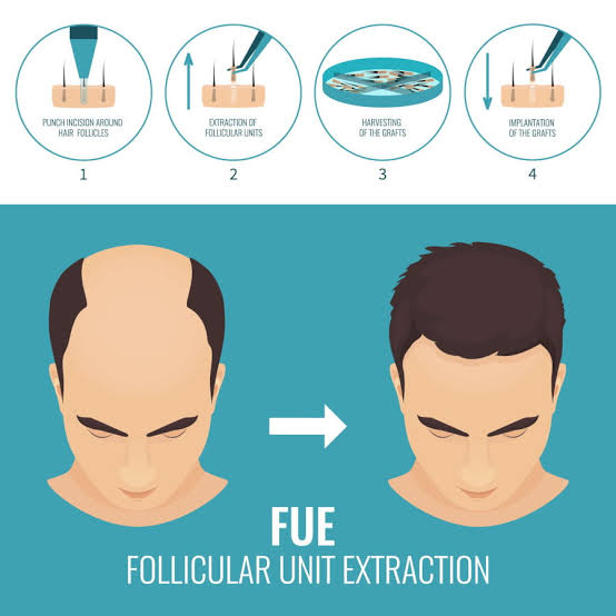 FUE Hair Transplant